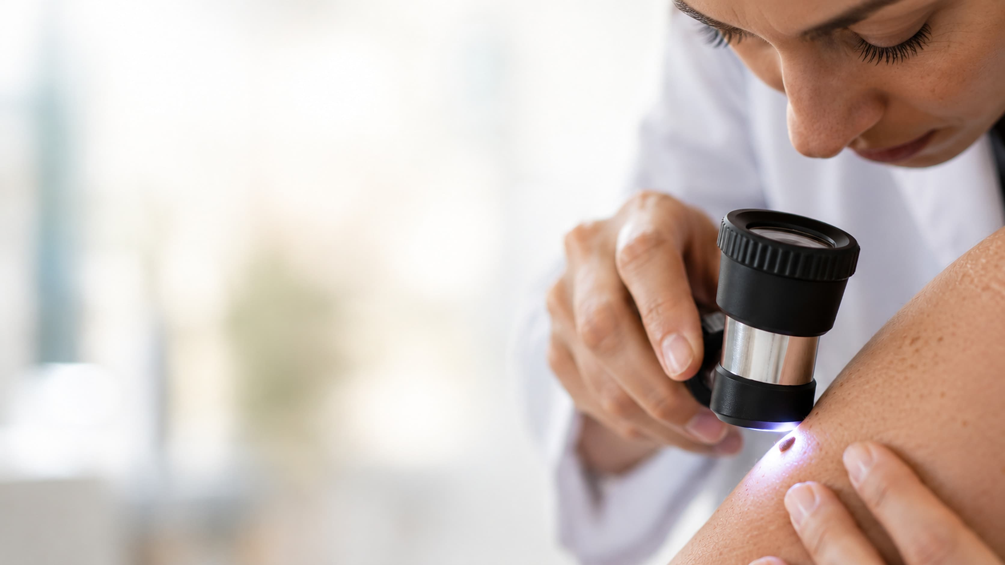 Dermatologista da DoctorÁgape examinando com o dermatoscópio iluminado uma pinta escura no braço de uma paciente, no consultório, em Joinville